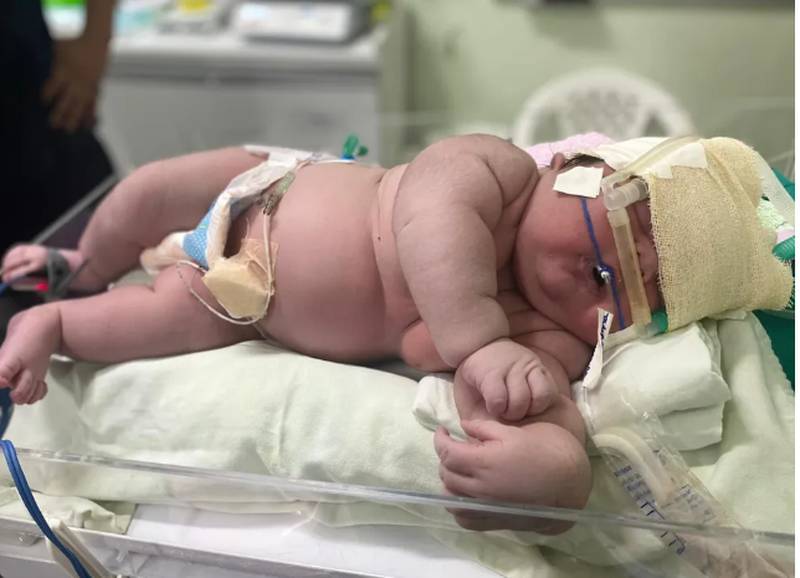 Bebê gigante nasceu com mais de 7 quilos