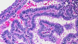 El carcinoma papilar es tres veces más común en las mujeres, según un experto
